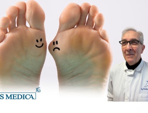 Alluce valgo prima e dopo: la correzione che dura